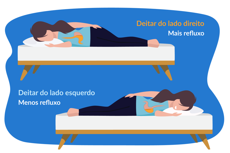 Ilustração mostrando a diferença entre dormir do lado direito e esquerdo, destacando que o lado esquerdo é melhor que o direito em relação ao refluxo.